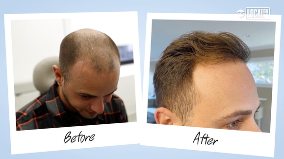 Using your own blood to regrow your hair